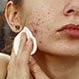 تم نشر مقالة علمية للدكتورة (رشا فاضل عبيد ) بعنوان  ?What causes acne