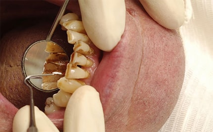 Scientific article Doaa Adel entitled The Effect of Smoking on Teeth