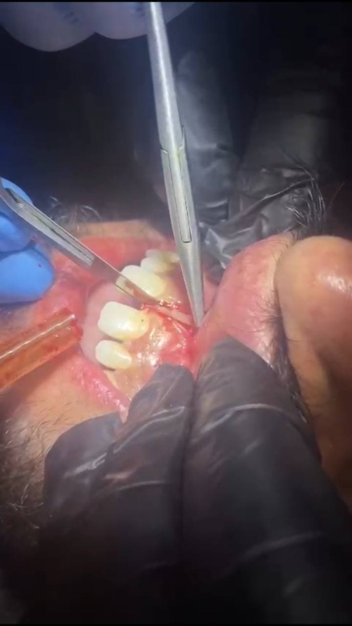 اجراء عملية قطع اللجام(Frenectomy ) في عيادات قسم طب الانسان