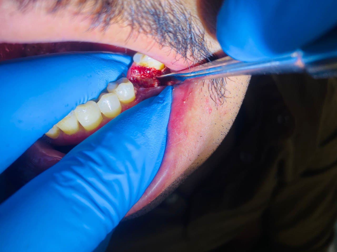 أجراء عمليه قلع الاسنان لاحد المراجعين في عيادات طب الأسنان داخل كلية المستقبل الجامعة