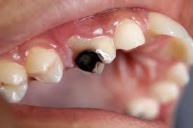 Tooth decay (cavities) ...م.م ريام عبد الخضر محمد