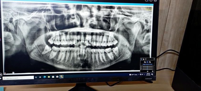 Surgical extraction of wisdom tooth in the dental surgery clinic