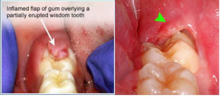مقالة علمية جديدة للدكتورة هنادي هادي بعنوان "Pericoronitis"