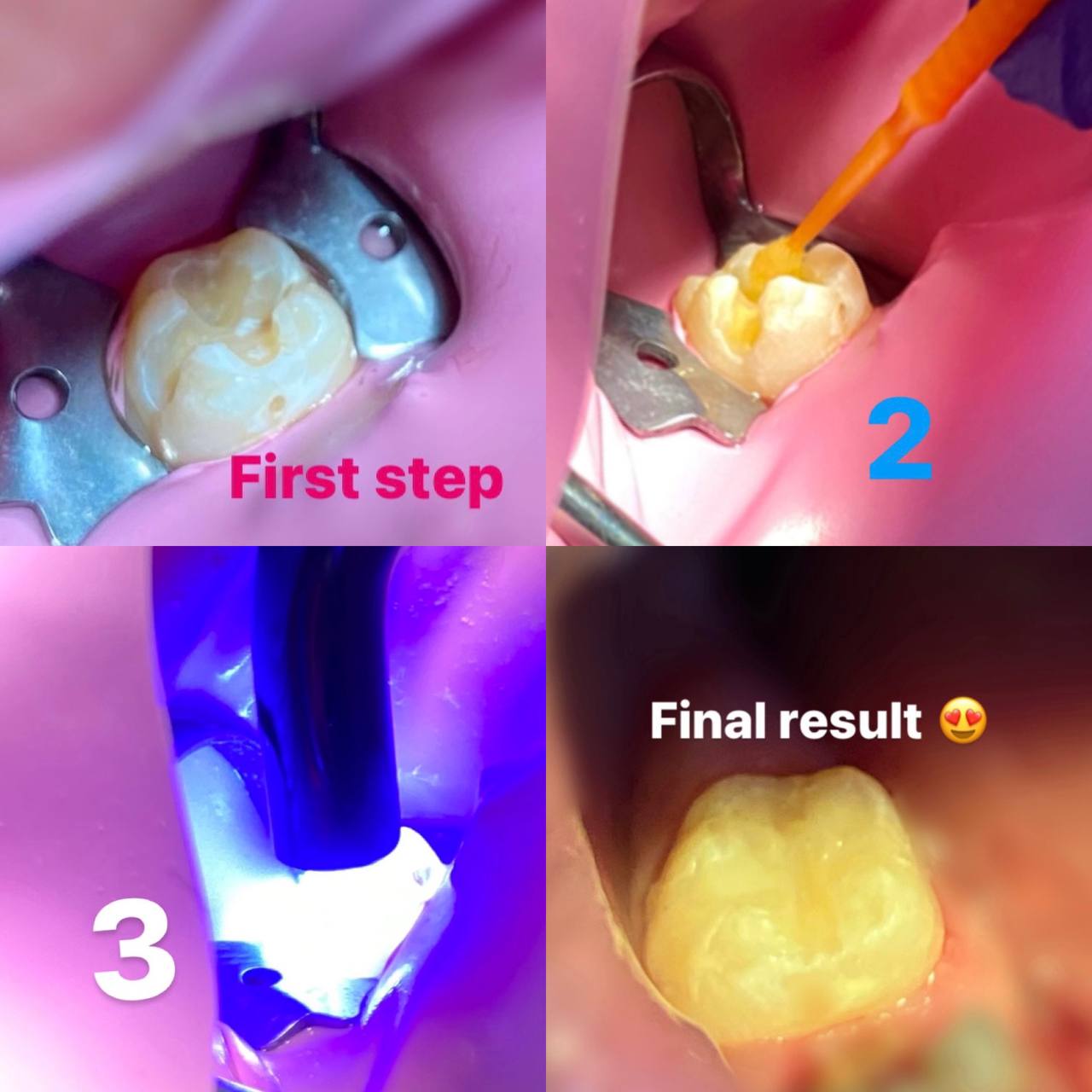 A COMPOSITE RESIN filling for a patient in dental clinics