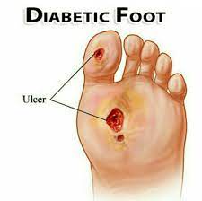 القدم السكري | Diabetic Foot                           