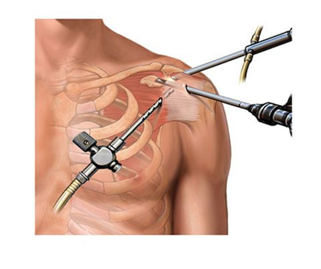 مقالة علمية في قسم تقنيات التخدير للتدريسي (د. محمد سامي حسن) بعنوان (Advances in Regional Anesthesia For Shoulder Surgery)