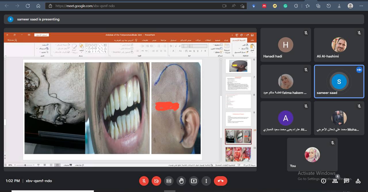 قسم طب الأسنان يقيم سمنار علمي بعنوان ( Ankylosis of the Temporomandibular Joint  " التصاق مفصل الفك الأسفل ")