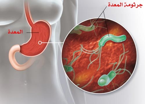 مقالة علمية للست ساره عبد الرزاق بعنوان جرثومة المعدة