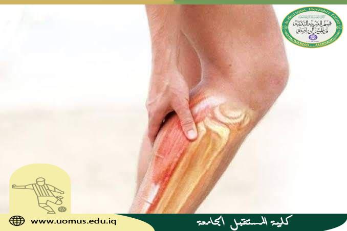 مقالة علمية للدكتورة افتخار مطر باقر تحت عنوان ( الشد العضلي ) 