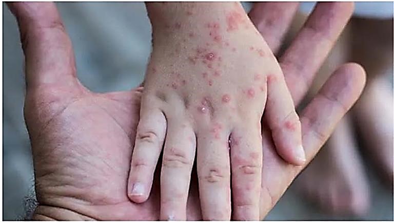 مقالة علمية للمدرس الدكتور زهراء محمد اياد بعنوان جدري القردة (Monkey pox virus)