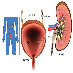7 diet tips to prevent kidney stones