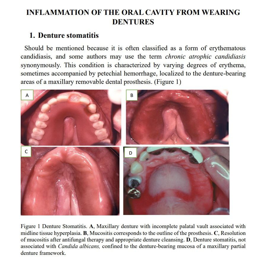 INFLAMMATION OF THE ORAL CAVITY FROM WEARING DENTURE