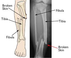 Bone Fracture