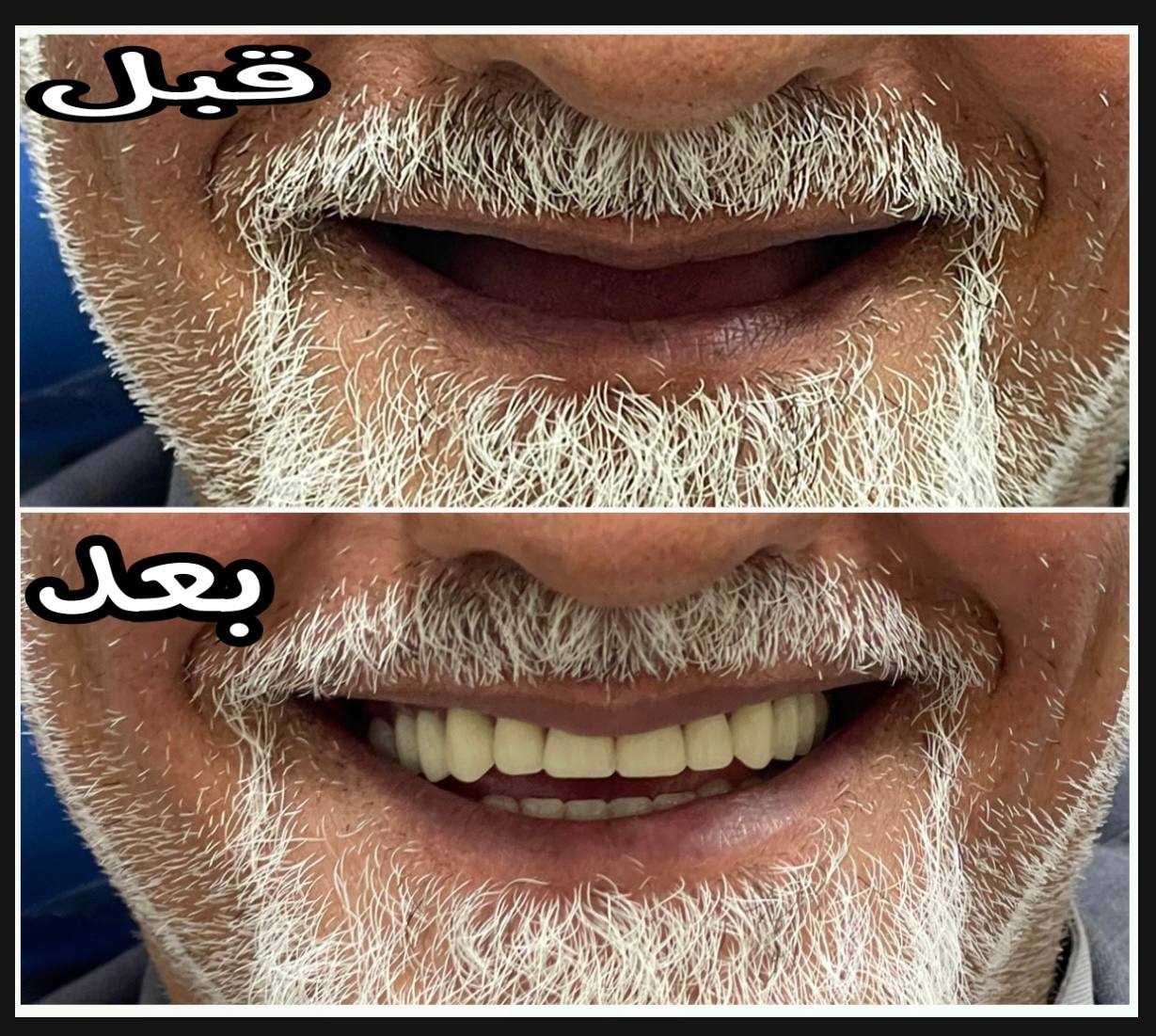 Student Zahraa Zaman creativity in making dentures for a patient