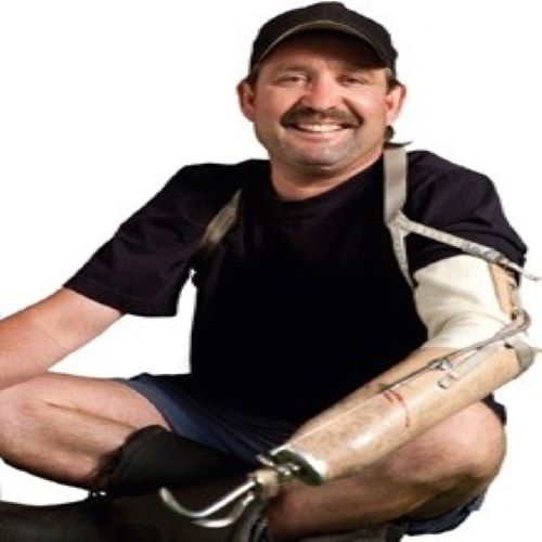 Prosthetic Options for Persons with Upper-Extremity Amputation