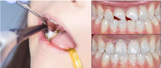 Dental Fillings