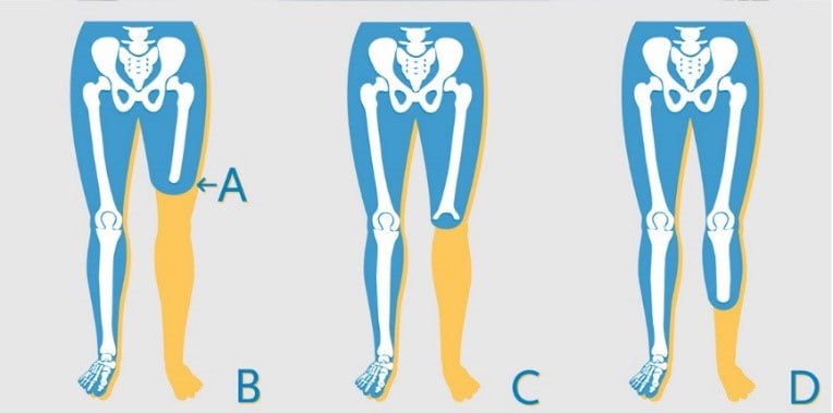 Knee Disarticulations and its Positive Aspects Compared to Transfemoral Amputation.