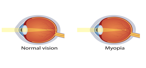 مقالة علمية للتدريسي م. م علي هادي معيدي بعنوان (قصر البصر : Myopia)