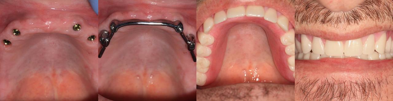 Over denture