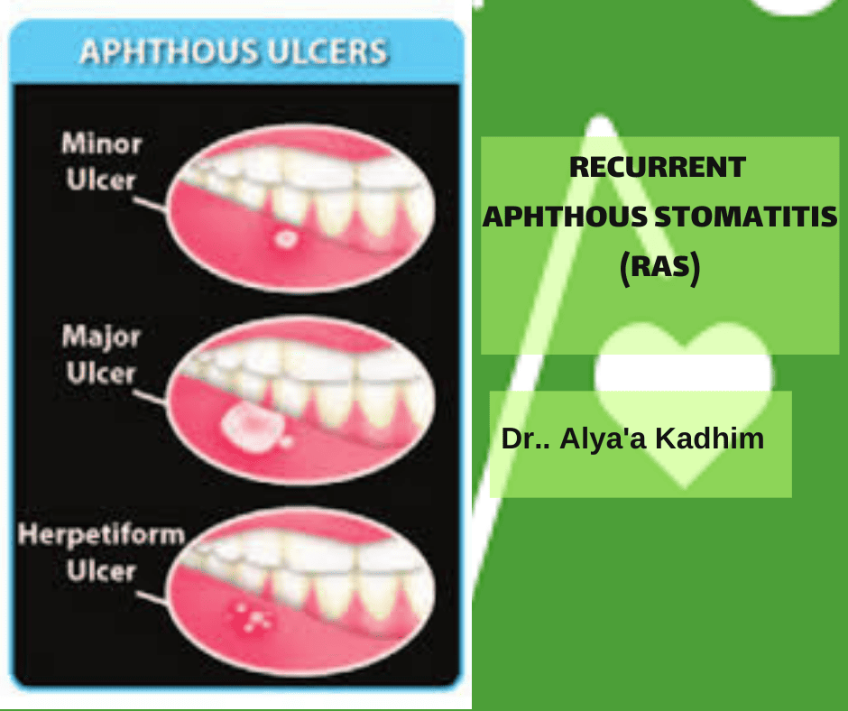 مقالة علمية للدكتورة علياء كاظم Recurrent aphthous stomatitis (RAS)