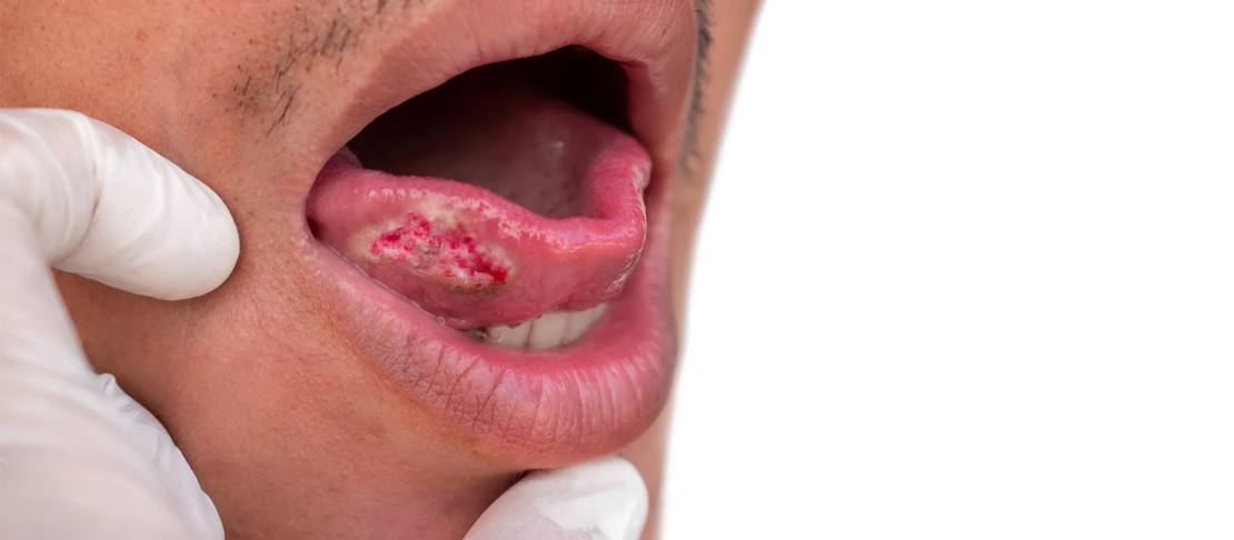 Mouth cancer