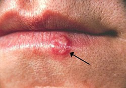 Recurrent herpes simplex labialis  