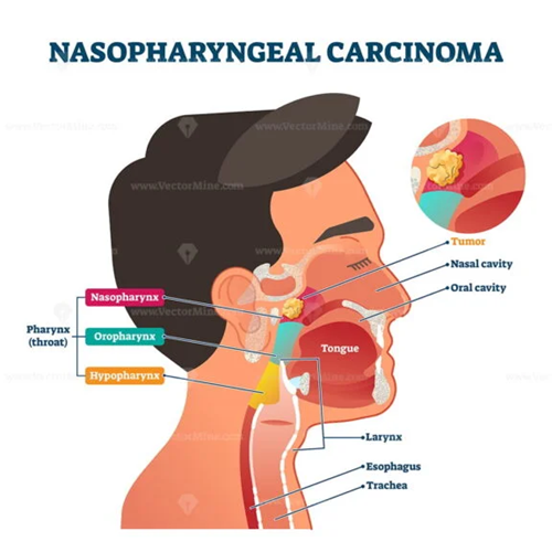 Scientific article by Dr. Ali Hussein Hamza Al-Nasrawi Otorhinolaryngologist and laser specialist  entitled (Nasopharyngeal Carcinoma) 