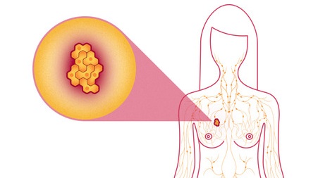 The Role of IVIM diffusion in  breast cancer diagnosis  BY DR MOHANED AHMED SAHIB