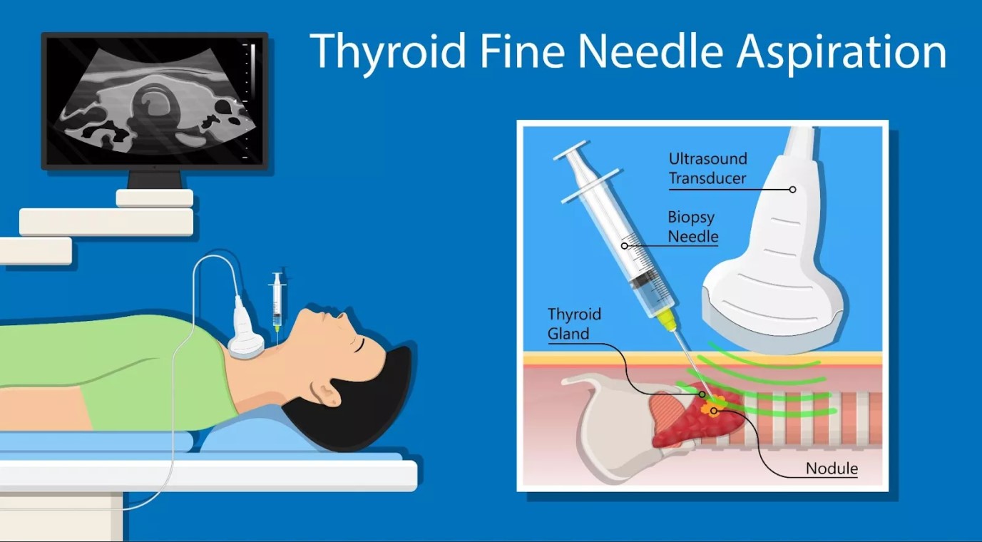 " Fine Needle Aspiration (FNA) Under Ultrasound Guidance "  by dr lames abdulrahem