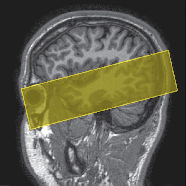 " MRI of Temporal lobes " by mohammed abdulkareem