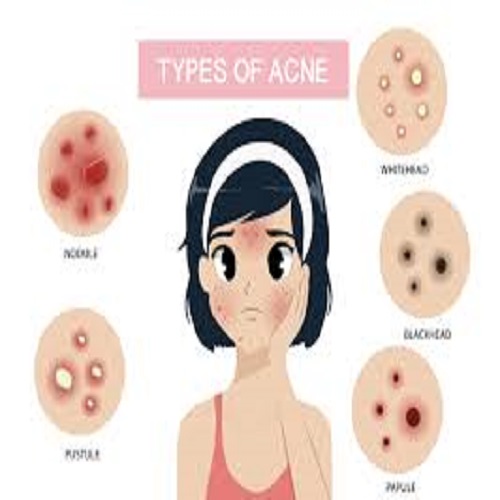 Acne vulgaris 