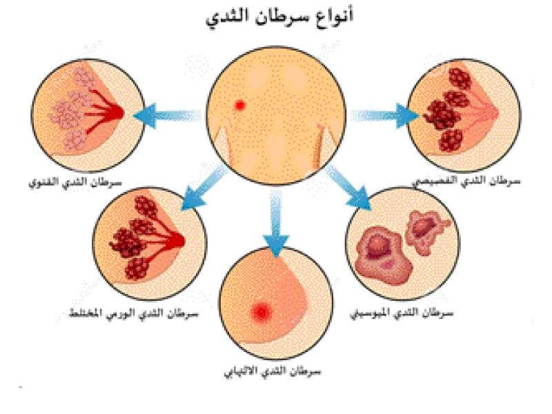 مقالة عن سرطان الثدي للتدريسية اصيل علي حسين 
