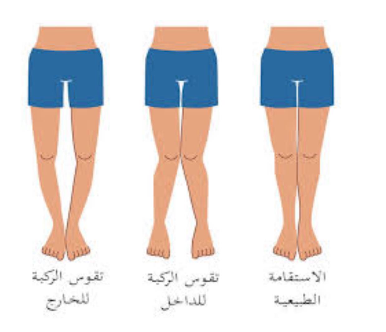 مقالة علمية للمعيدة ايلاف علي عبيد حول مرض كساح الاطفال 