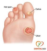 مقالة:القدم السكري (Diabetic Foot)