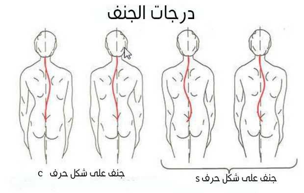 مقالة علمية بعنوان "الجنف (ميلان جانبي في العمود الفقري)" للطالبة (علياء شاكر صلال) جامعة المستقبل-كلية العلوم-قسم علوم الفيزياء الطبية- المرحلة الثالثة_كروب وبأشراف (م .م علي جعفر عبيد)