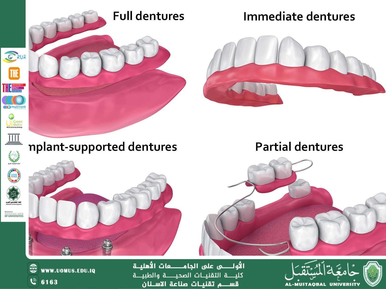 Type of complete denture