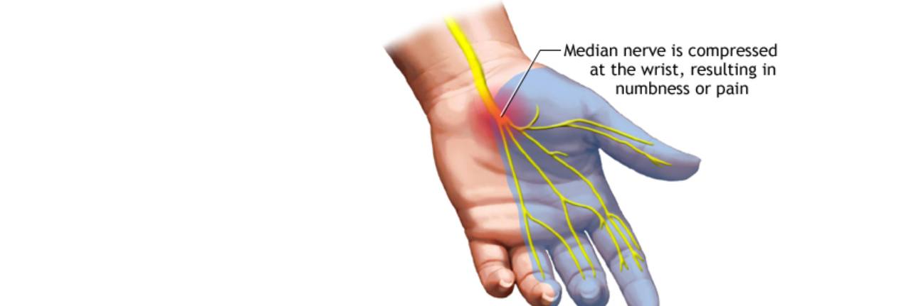 Carpal tunnel syndrome