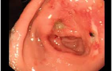 Stomach Ulcers and What You Can Do About Them