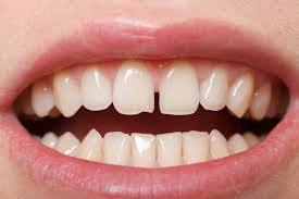 مقالة بعنوان ( Diastema )