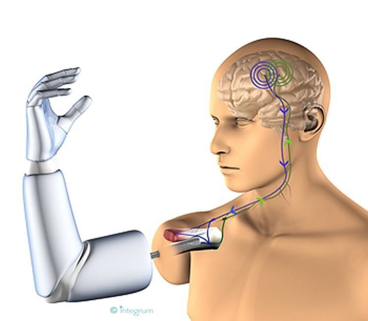 Neural Prosthetics: A Technological Revolution Empowering the Brain to Control Lost Limbs