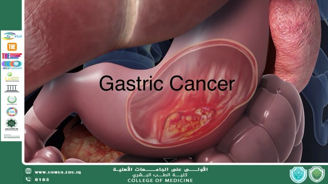 Gastric cancer
