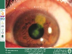 An article by the lecturer Nilofer Ali entitled(Viral Dendritic ulcer of the eye)