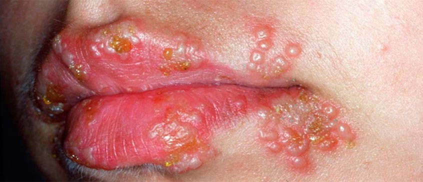 Scientific article entitled  Recurrent herpes simplex labialis