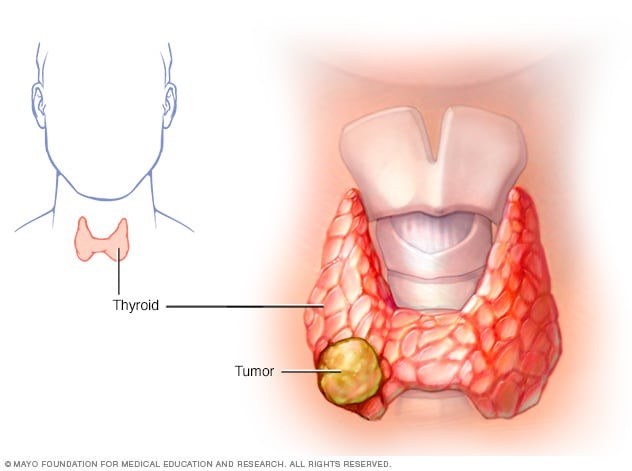 Thyroid cancer  by dr. lamees abdulraheem 