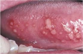 Scientific article entitled  Aphthous Ucer 