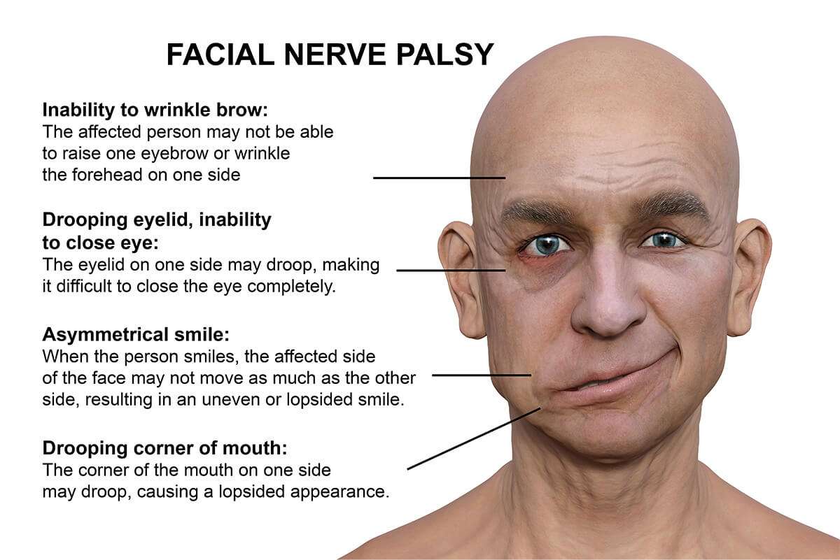 Scientific article entitled   Facial palsy 