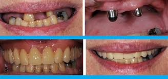 Scientific article entitled  telescopic overdenture