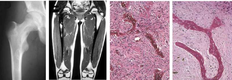 Fibrous Dysplasia and Pregnancy