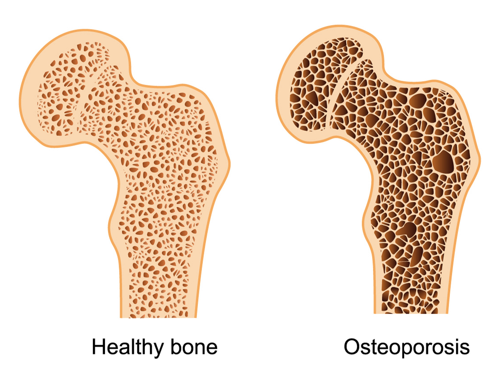 Osteoporosis: A Comprehensive Overview