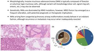 Mucinous Adenocarcinoma